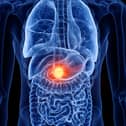Here are signs of pancreatic cancer you can look out for 
