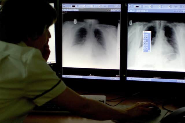Charity TB Alert says sufferers may be at an increased risk from coronavirus