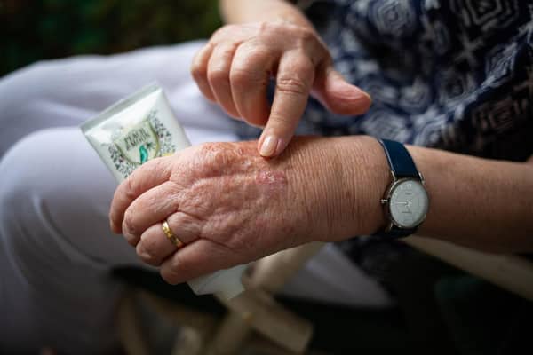 1,263 people in Bedford had rheumatoid arthritis (Pixabay)