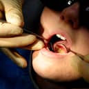 There were an estimated 75 hospital admissions in Bedford for children's tooth extraction in the year to March 2023. Of these, about 20 were extractions for tooth decay