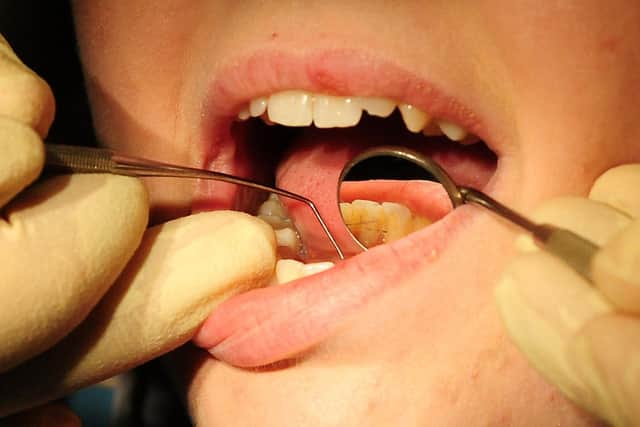 66 in every 100,000 children in Bedford underwent a tooth extraction for decay last year